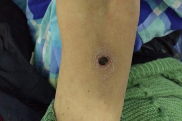 恙虫病胳膊黑痂图片