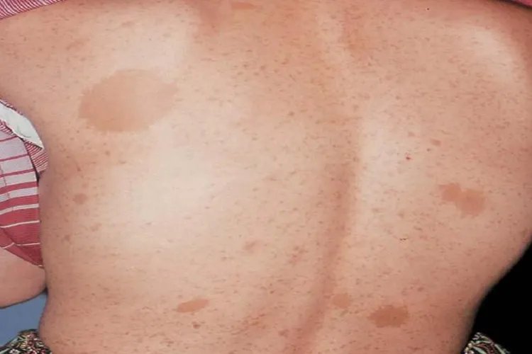 MAS综合征的牛奶咖啡斑图片