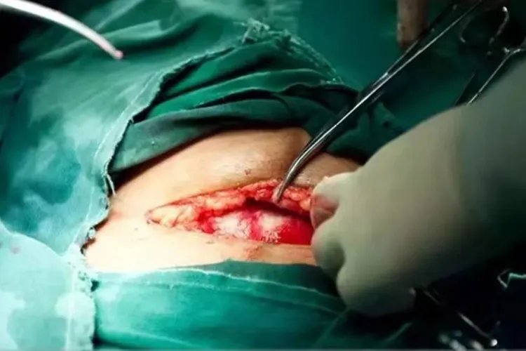 剖腹产7层全过程图片