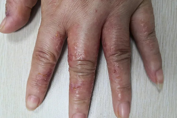 湿疹初期图片