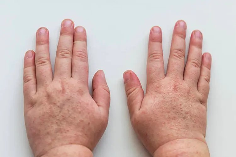 宝宝身上出现很多小红疹图片