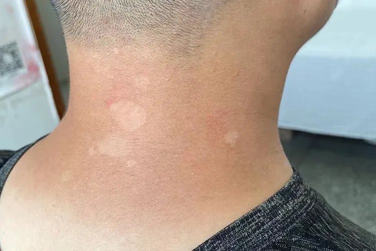 脖子上花斑癣图片大全