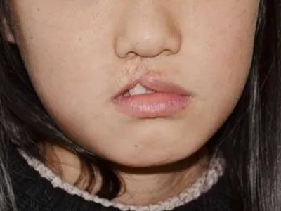 唇裂症状图片