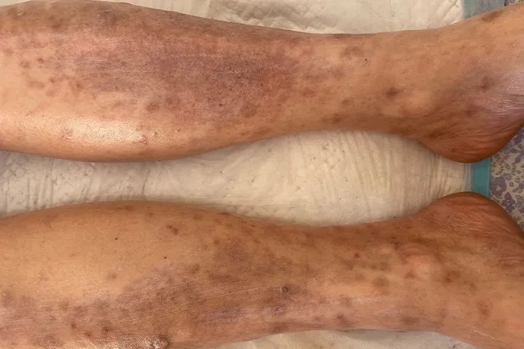 皮肤病湿疹对照图片