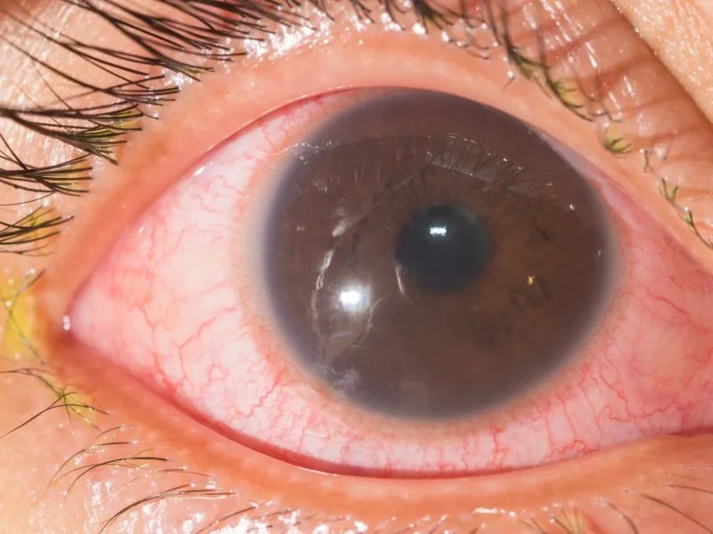 红眼病如何预防