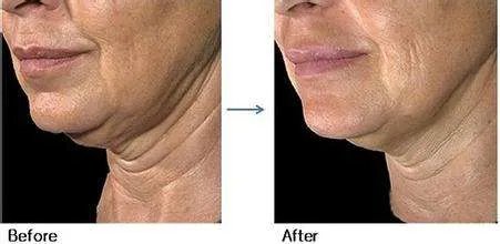 光子嫩肤能去除面部皱纹吗