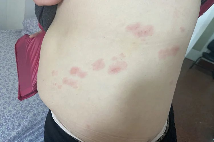 蜘蛛疮长什么样子