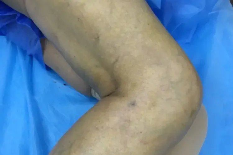 下肢静脉曲张初期症状图片