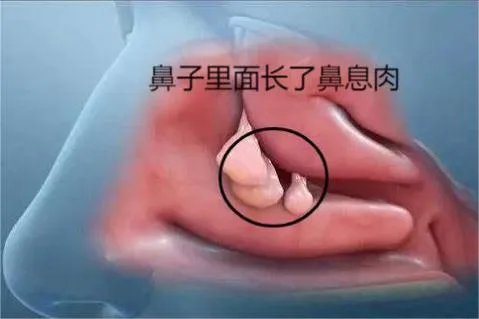 鼻子里面长了鼻息肉图片