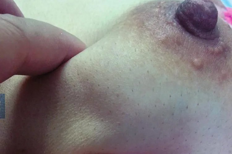 乳腺癌的15个征兆图片