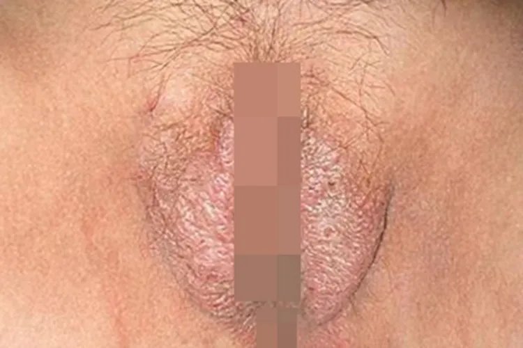 外阴白色病变症状图片