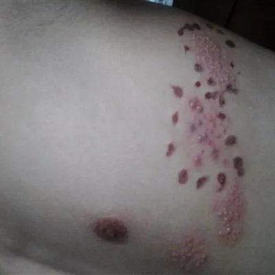 韦格纳肉芽肿怎么得的?