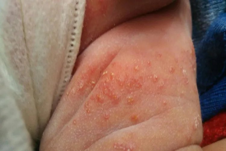 皮炎图片和症状用什么药