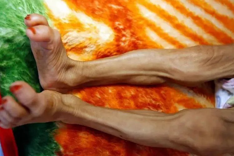 厌食症患者的图片