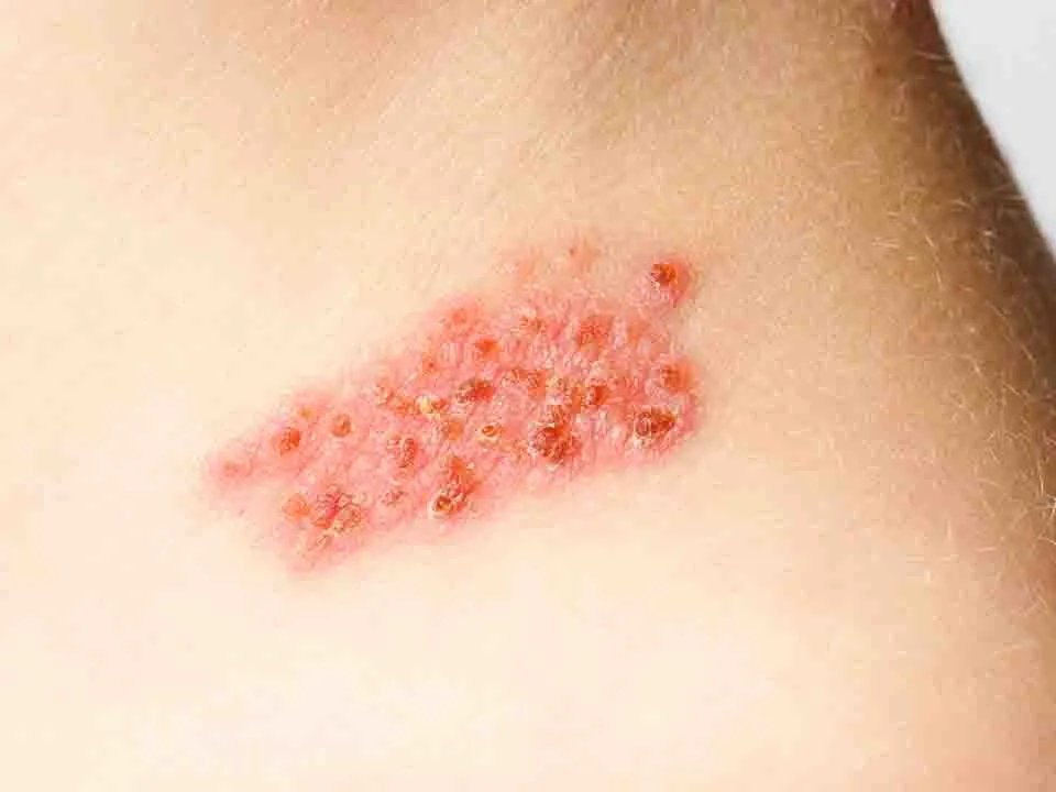 带状疱疹怎么治疗好的快