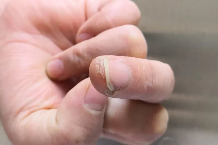 什么是刺瘊子图片大全