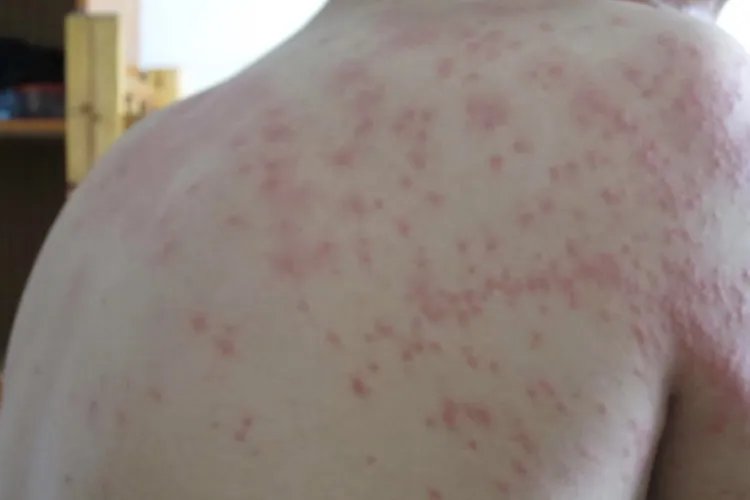 身上起了好多红疙瘩图片
