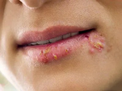 单纯疱疹水疱图片