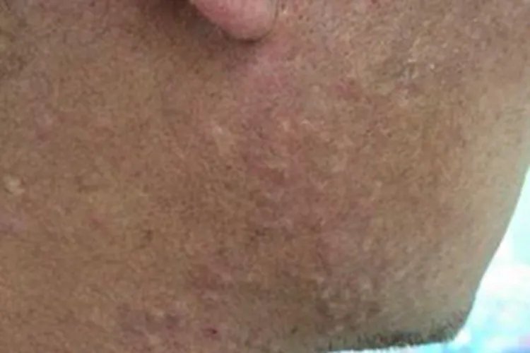 全身性瘙痒症丘疹图片