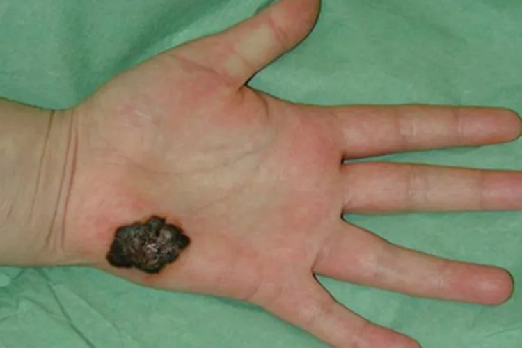 黑素瘤症状图片