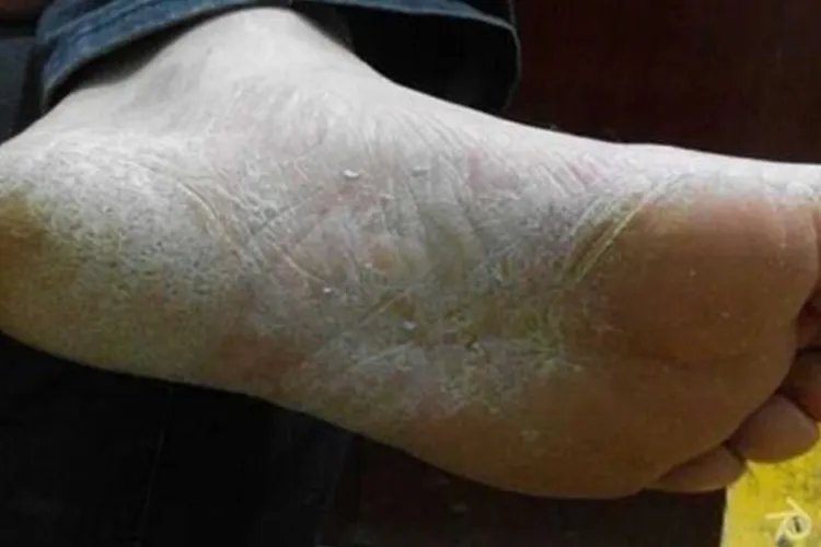 脚底皮肤病症状及图片