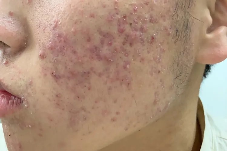 常见皮肤病对照图