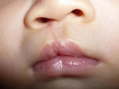唇裂症状图片