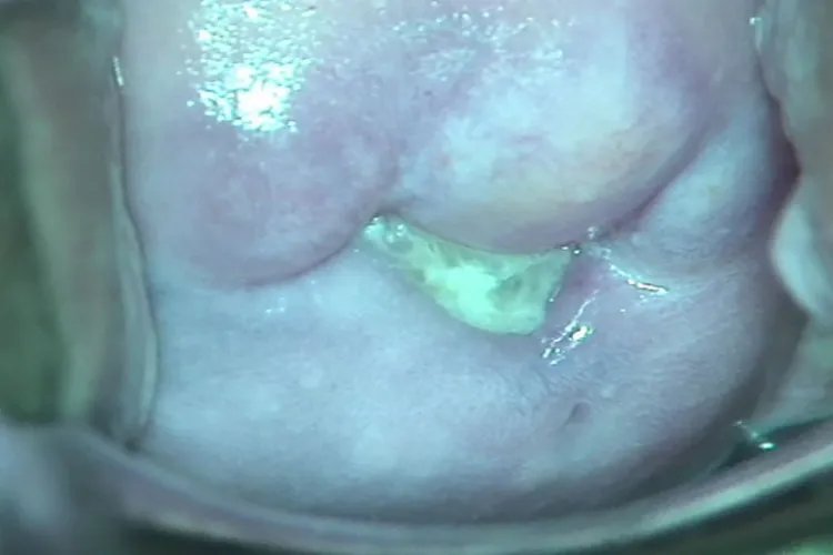 白带正常和不正常的图片