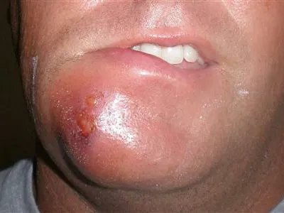 蜂窝织炎红肿图片