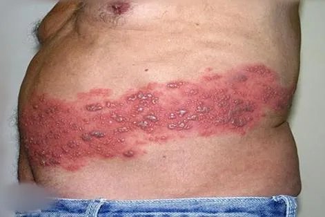 蛇盘疮图片 初期 晚期