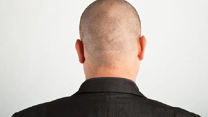 脑血栓形成应该如何治疗