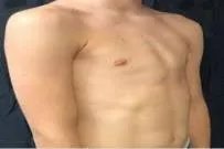 鸡胸图片正常人