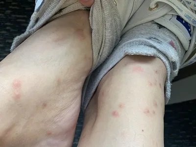 跳蚤叮咬丘疹图片