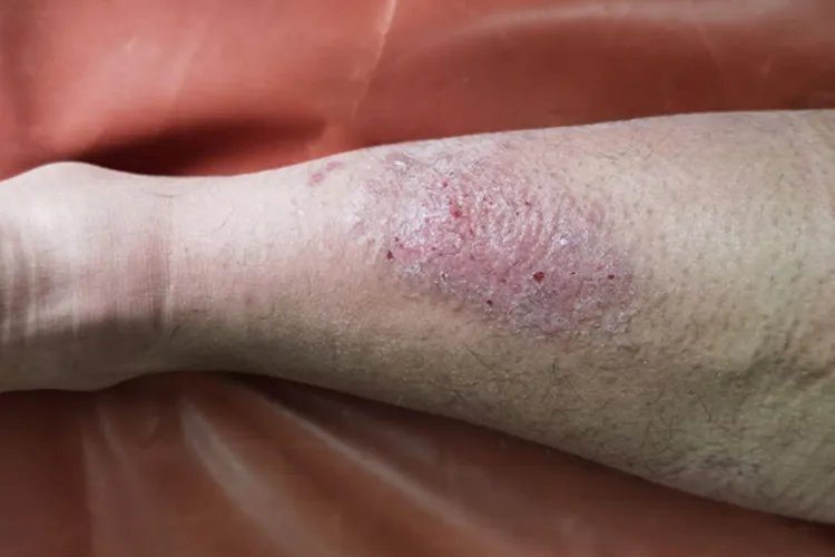 小皮疹图片大全