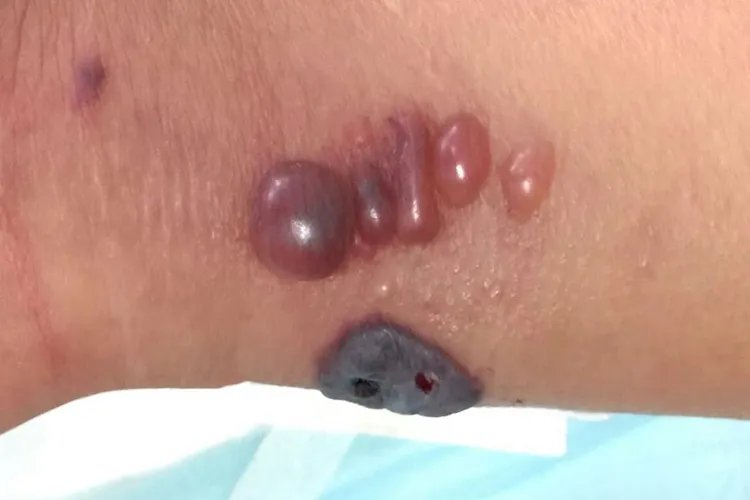 人体皮肤炭疽病图片