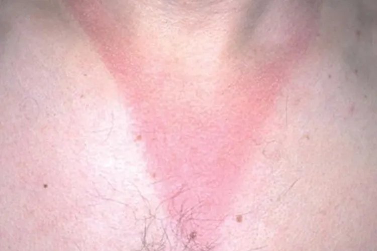 5种荨麻疹症状分析图片