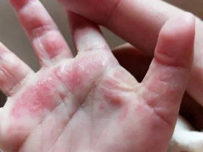 手部湿疹红斑图片