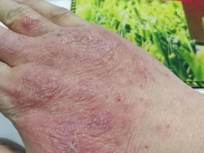 手部湿疹红斑图片