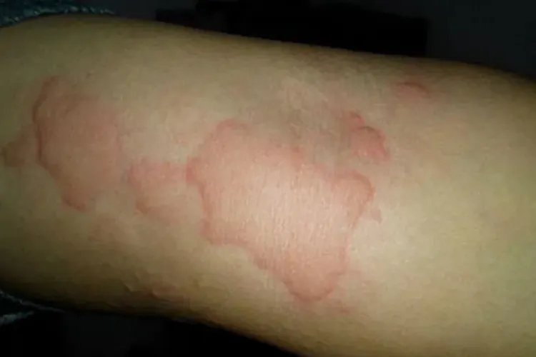 5种荨麻疹症状分析图片