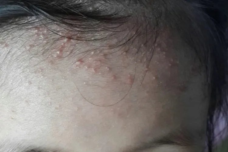 痱子长啥样图片