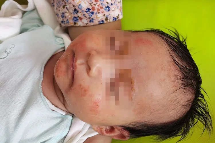 小孩湿疹图片