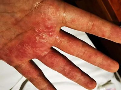 手部湿疹红斑图片