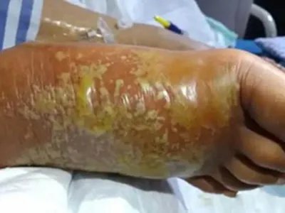 蜂窝织炎红肿图片