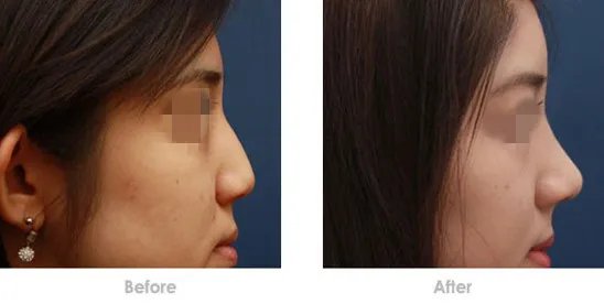 注射瑞蓝玻尿酸隆鼻的价格