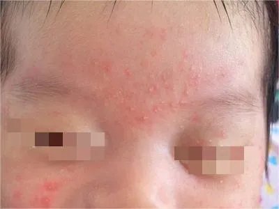 奶癣小红疙瘩图片