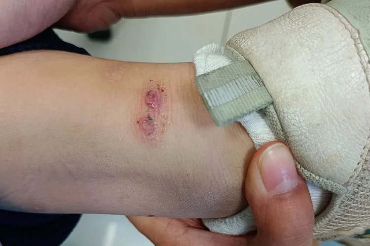 丘疹性荨麻疹的初期症状图片