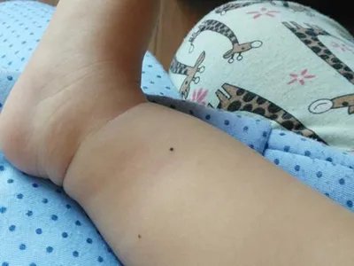 交界痣黑痣图片