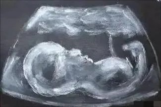 怀孕4个月b超图片