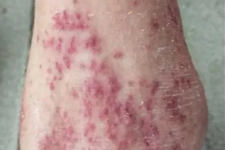 全身性瘙痒症丘疹图片