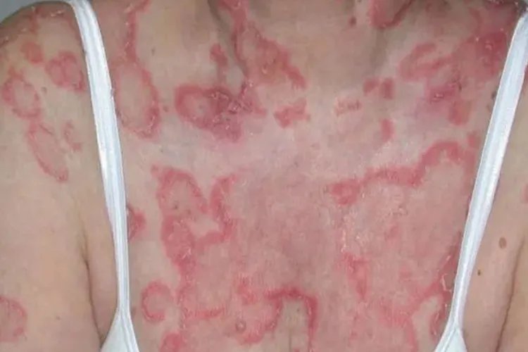 轻度红斑狼疮图片